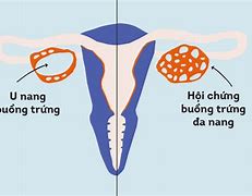 Cắt 2 Vòi Trứng Có Ảnh Hưởng Đến Buồng Trứng Không